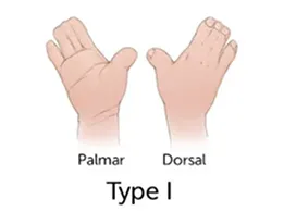 type 1